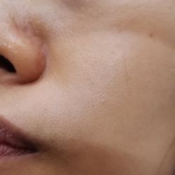 体验后-东莞缔美美容医院