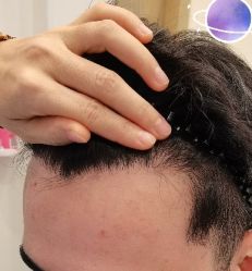 -大麦微针植发丨全国连锁