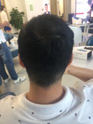 点击看大图 体验后-大麦微针植发全国连锁