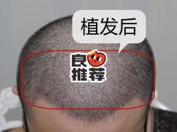 -大麦微针植发全国连锁