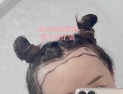 点击看大图 -新生植发·植养护一体