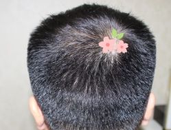 -大麦微针植发丨全国连锁