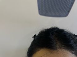 -碧莲盛·不剃发植发