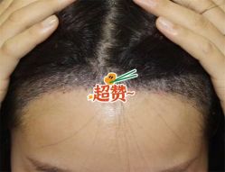 -大麦微针植发全国连锁