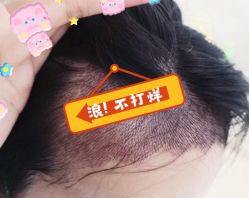 -大麦微针植发全国连锁