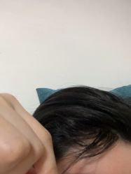 点击看大图 -大麦微针植发丨全国连锁