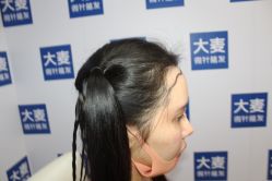 -大麦微针植发丨全国连锁