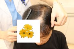 -大麦微针植发丨全国连锁