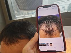 -碧莲盛·不剃发植发