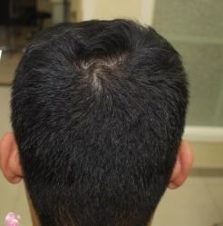 -大麦微针植发丨全国连锁