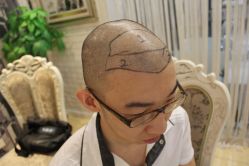 点击看大图 -大麦微针植发丨全国连锁