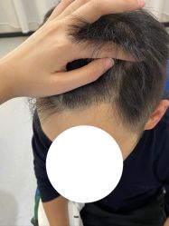 -大麦微针植发全国连锁