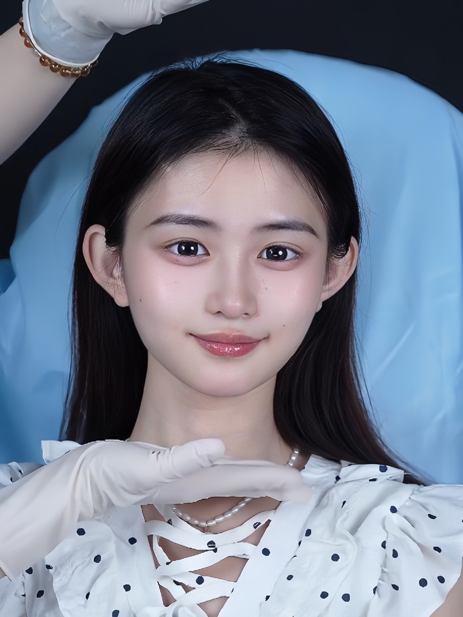 【润致双相 3 号玻尿酸】体验后当天效果分享