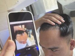 -碧莲盛·不剃发植发