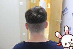 点击看大图 -大麦微针植发丨全国连锁