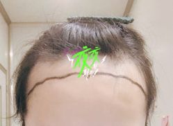 -大麦微针植发全国连锁