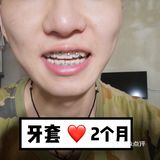 【案例分享】今天我们来讲个小帅哥的正畸案例