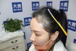 -大麦微针植发丨全国连锁