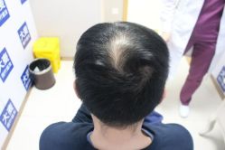 体验前-大麦微针植发丨全国连锁