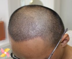 -大麦微针植发丨全国连锁