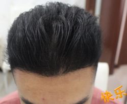 -大麦微针植发丨全国连锁