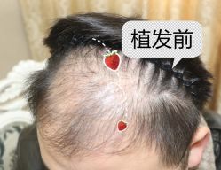 -大麦微针植发全国连锁