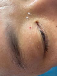 体验前-爱莎扁平疣·汗管瘤·斑痣中心