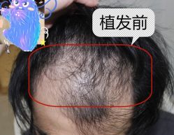 -大麦微针植发全国连锁