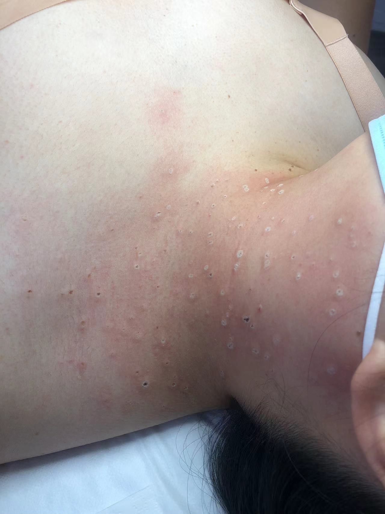 脖子上好多疣困扰了好多年现在把它弄下去心