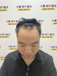 体验前-大麦微针植发全国连锁