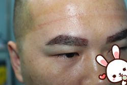 -大麦微针植发丨全国连锁