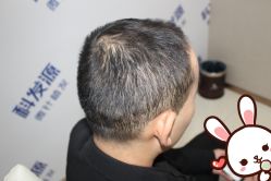 -大麦微针植发丨全国连锁