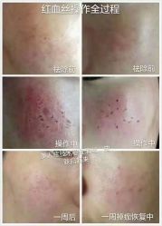 -美人痣全国连锁