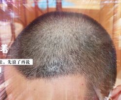 -大麦微针植发全国连锁