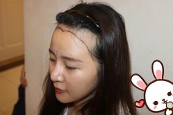 点击看大图 -大麦微针植发丨全国连锁