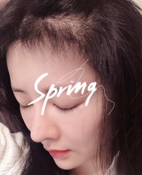 -大麦微针植发全国连锁