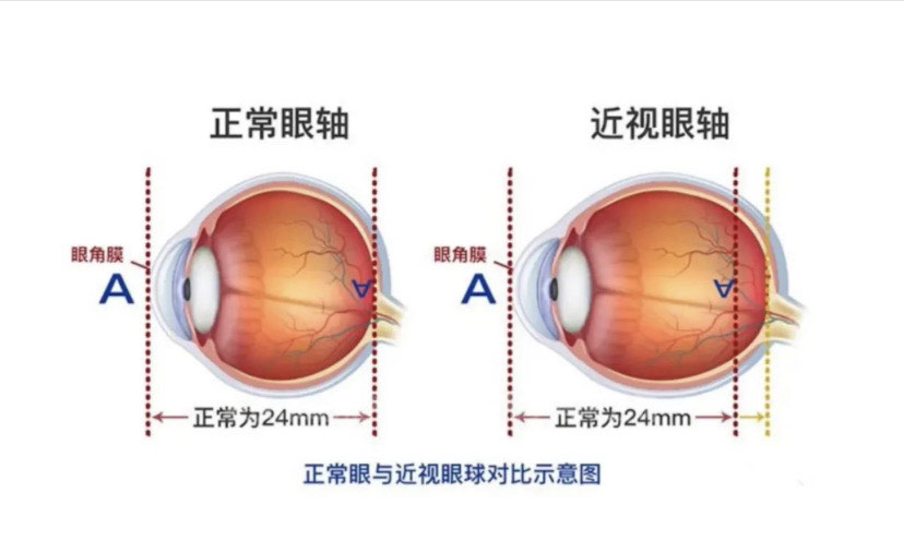 儿童近视眼的可怕图片图片