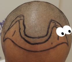 -大麦微针植发全国连锁