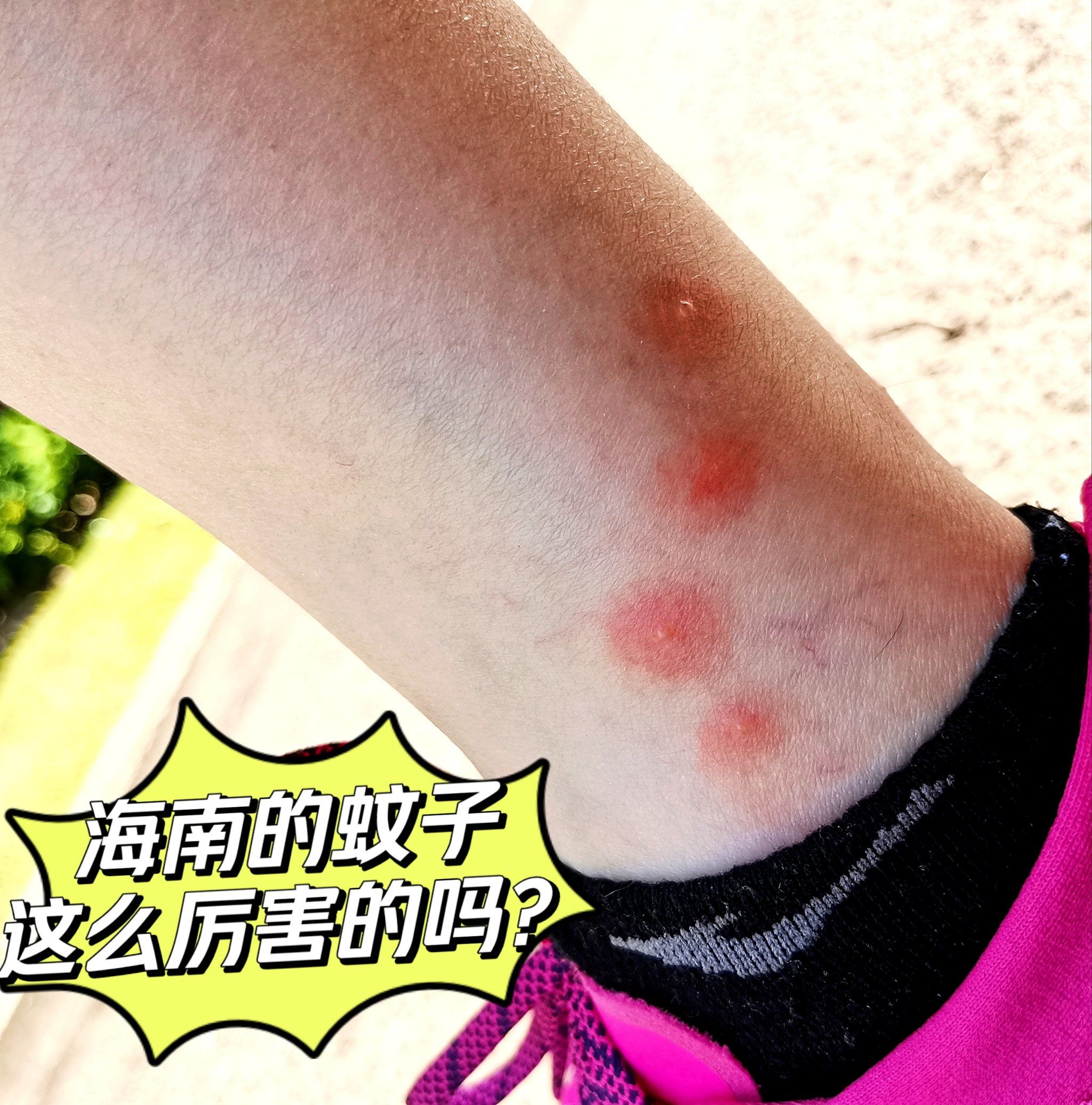 就想问问海南的蚊子这么厉害的吗?