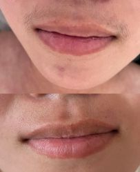 -薇兰专业脱毛连锁机构