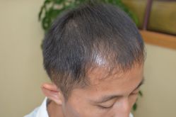 -大麦微针植发丨全国连锁