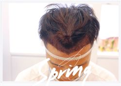 体验后-大麦微针植发全国连锁