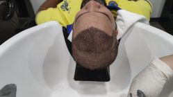 -大麦微针植发全国连锁