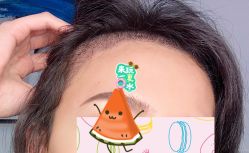 -大麦微针植发全国连锁