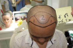 -大麦微针植发丨全国连锁