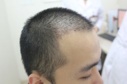 点击看大图 -大麦微针植发丨全国连锁