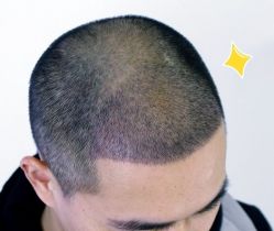 -大麦微针植发丨全国连锁