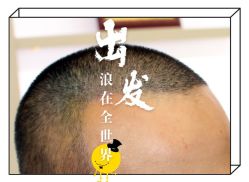 -大麦微针植发全国连锁