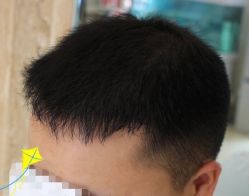 -大麦微针植发丨全国连锁