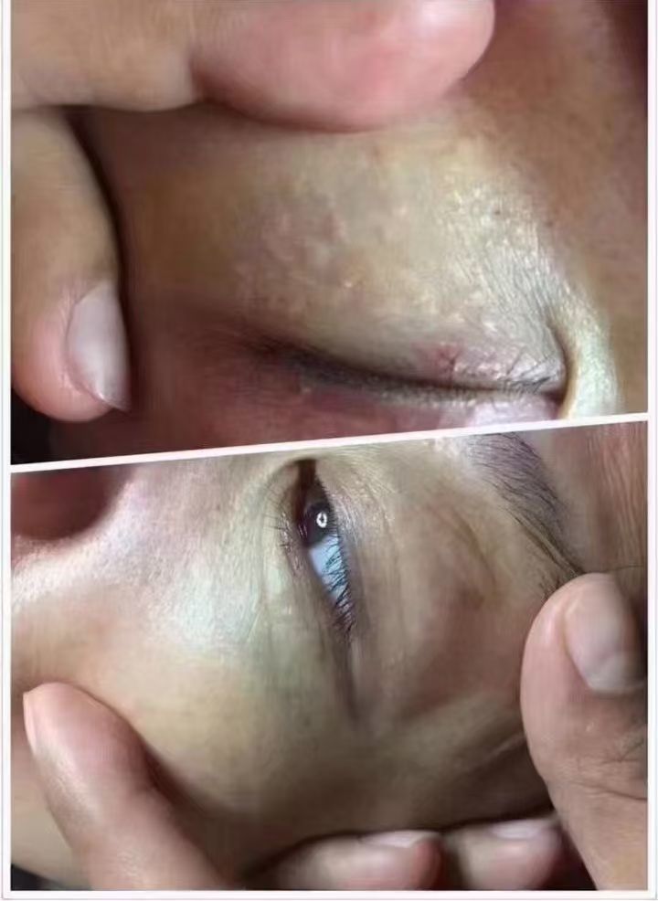 n
汗管瘤好发于人的下眼睑及面颊上部皮肤,亦可见于颈侧,胸部,外